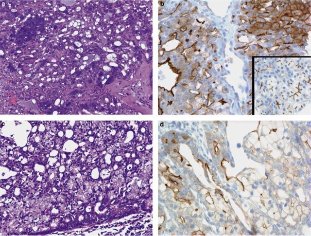 DOG1: a novel marker of salivary acinar and intercalated duct differentiation.