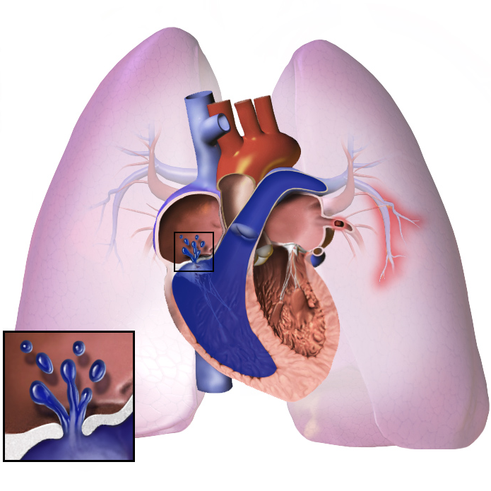 Pulmonary Hypertension