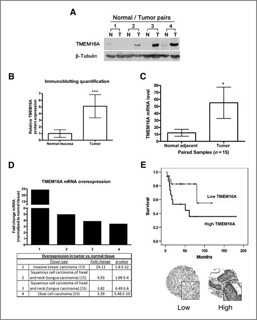 TMEM16A, induces MAPK and contributes directly to tumorigenesis and cancer progression